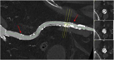 Case Report: Lithoplasty-Assisted Trans-Axillary Transcatheter Aortic Valve-in-Valve Implantation